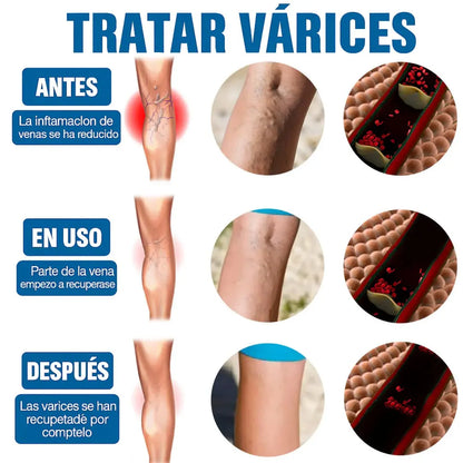 Venaderm Pro® - Spray Terapéutico para Várices