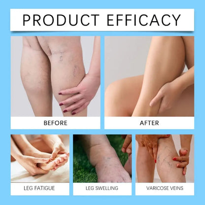 Venaderm Pro® - Spray Terapéutico para Várices